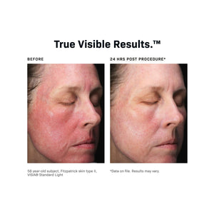 CMT Post-Procedure Cream