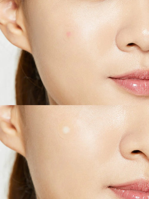 Acne Pimple Master Patch 24pz