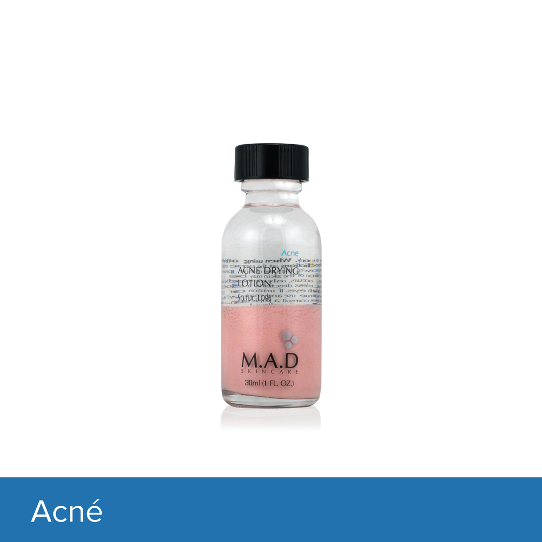 Acne Drying Lotion Sulfur 10%, tratamiento nocturno para combatir espinillas.